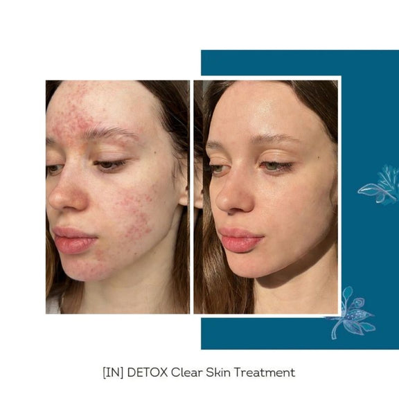 FLOREVE_IN_DETOX_Clear_Skin_Cure_Before_After