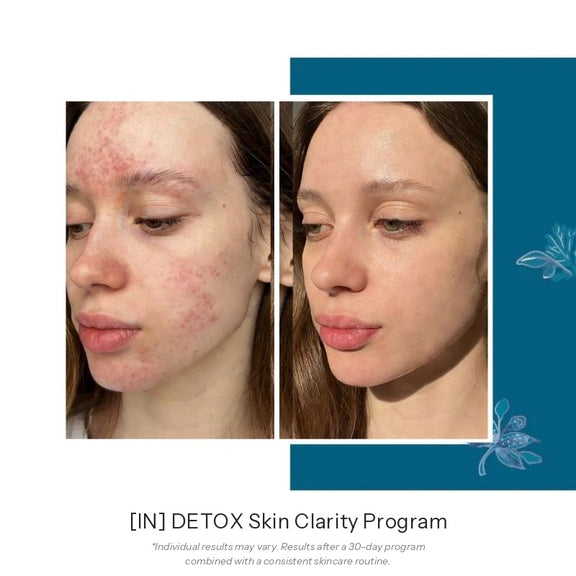 FLOREVE IN DETOX Skin Clarity Before and After