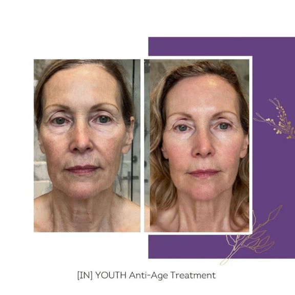 FLOREVE_IN_YOUTH_Anti-Aging_Before_After