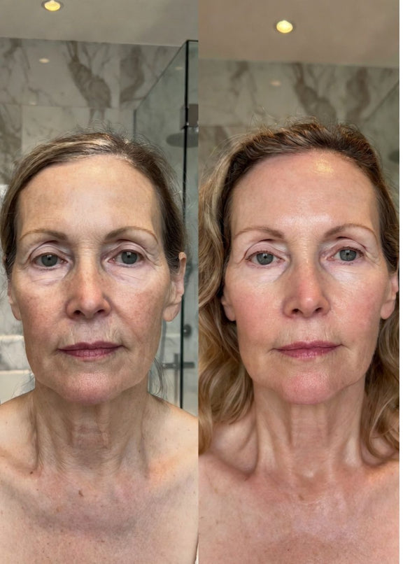 Floreve Anti Age Before and After