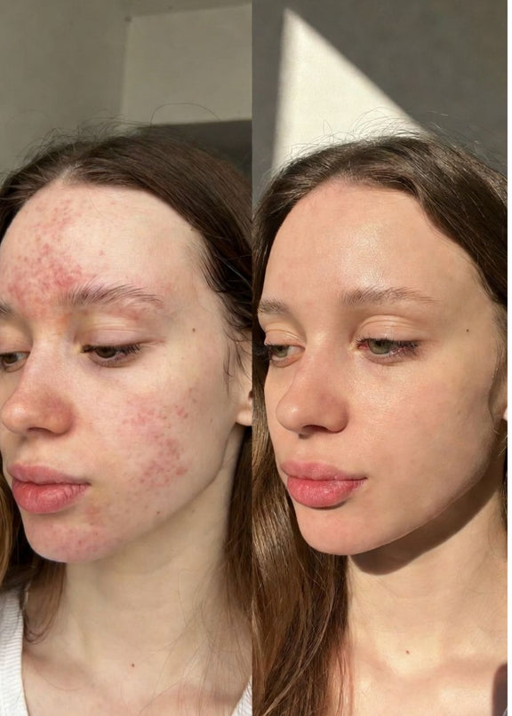 Floreve Detox Before and After