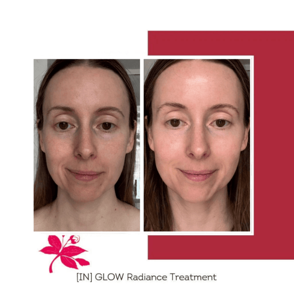 Floreve_IN_GLOW_Before_vs_After_transformation